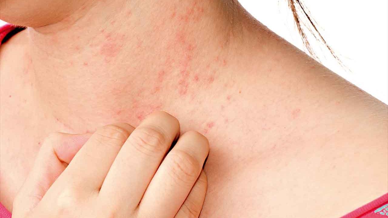 針藥協同 標本兼顧 中醫精準施治濕疹