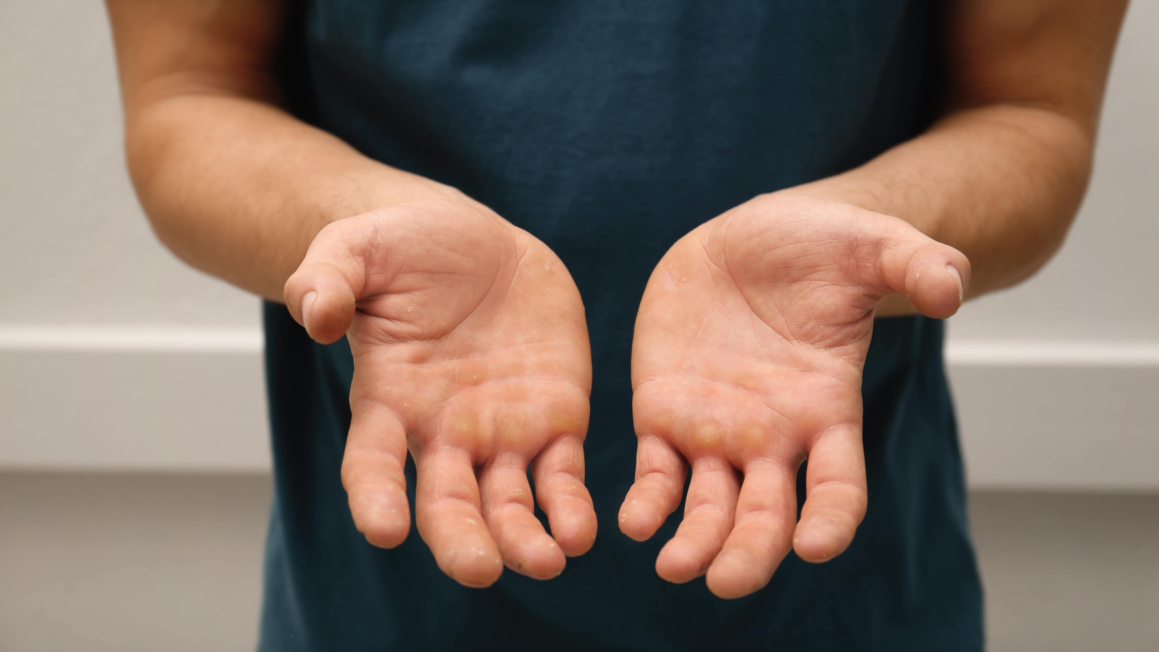 參加HYROX比賽！手會長繭？ 