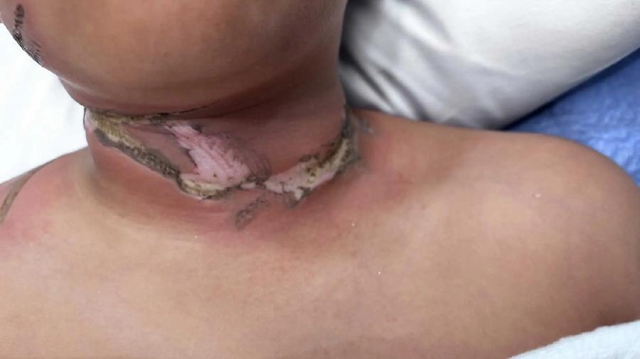 頸鍊纏住平板充電線起火 睡夢中驚醒男童頸燒燶