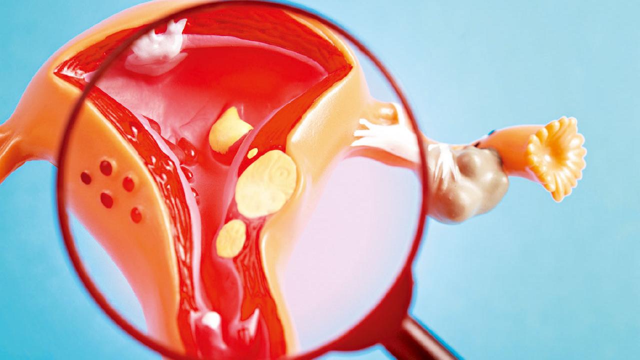 子宮肌瘤年輕化 不治理或礙生育