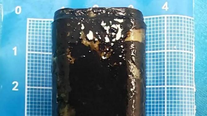 胃部藏發黑打火機「特別手術」取出 四川漢憶起33年前飲醉打賭往事