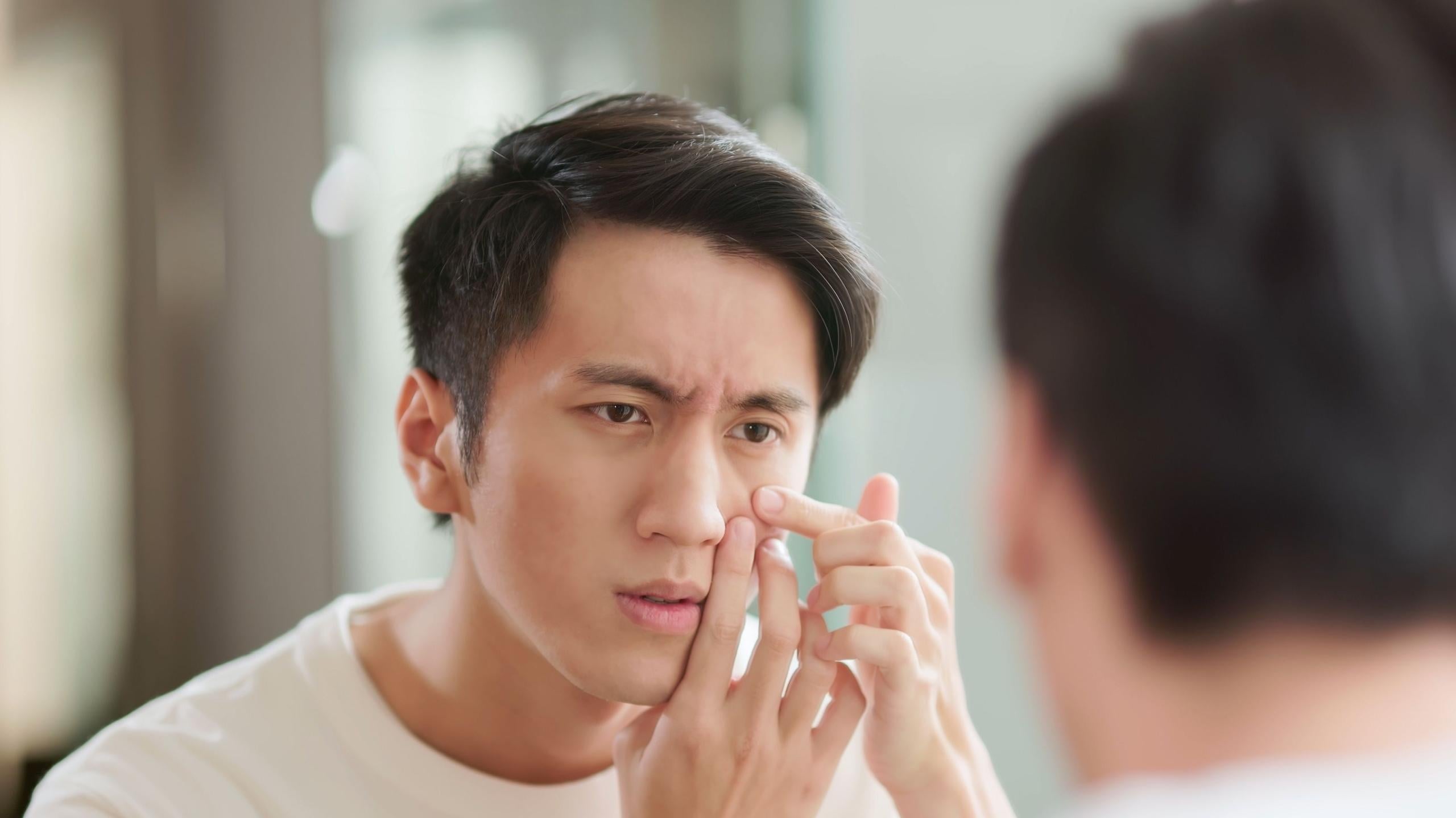 青春痘問題總令青少年困擾，醫生提醒患者把握3個月的「黃金治療期」改善膚況。