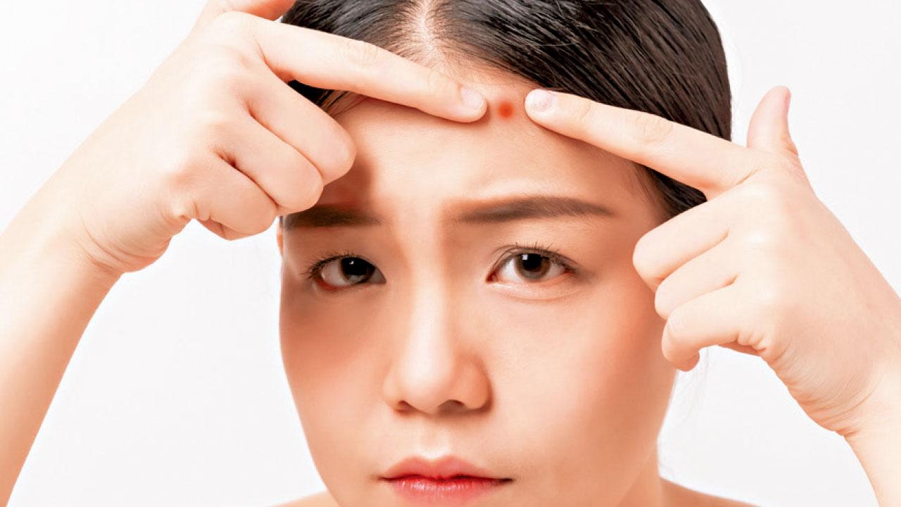 亂擠暗瘡  恐毀容致命？