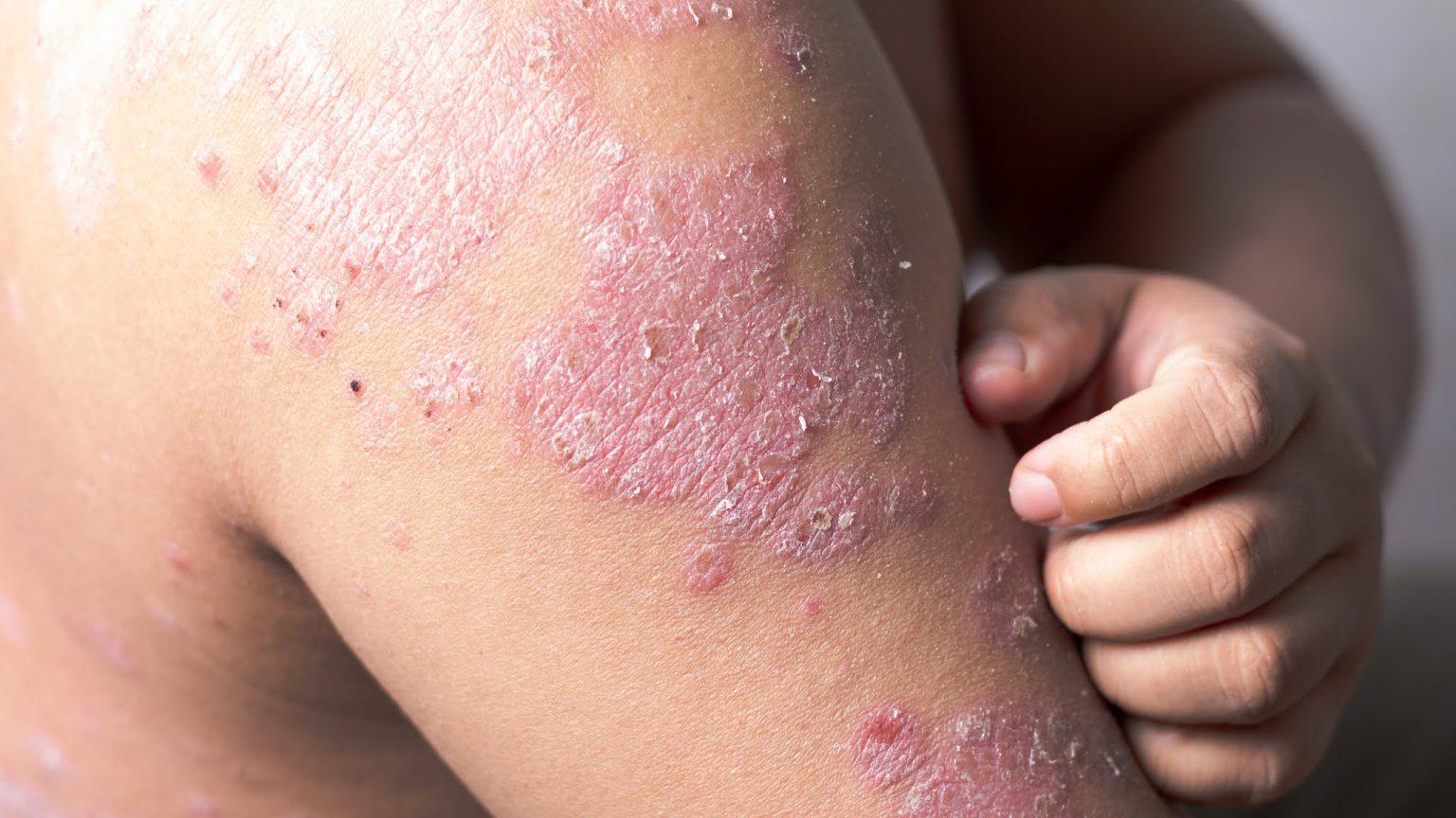 異位性皮膚炎屬慢性疾病，治療與日常護理需並行，建議洗澡以溫水為宜，避免過熱與過度搓洗；冬季更要加強保濕，並減少接觸致敏原與刺激性清潔用品。