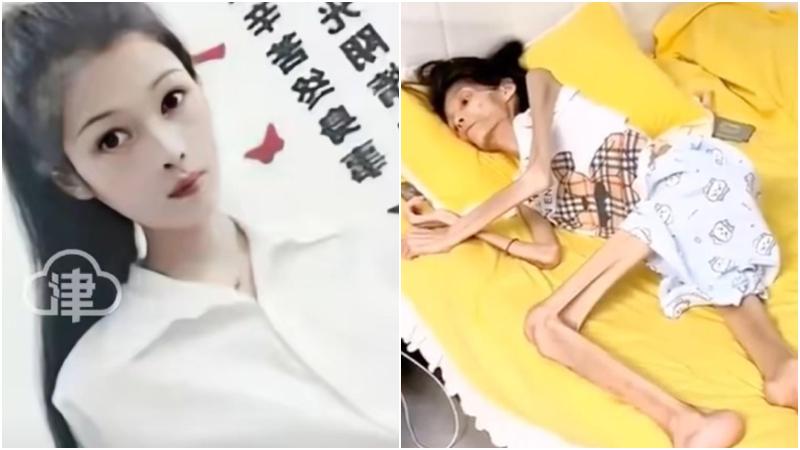 27歲女子「巧巧」罹患重度胃萎縮生前體重剩17公斤。（圖／翻攝微博）