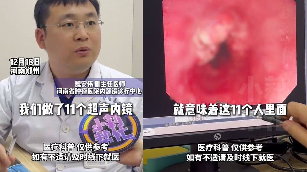 食道癌｜河南醫院上午11人確診末期癌症　醫生：天氣凍也但勿食太熱食物
