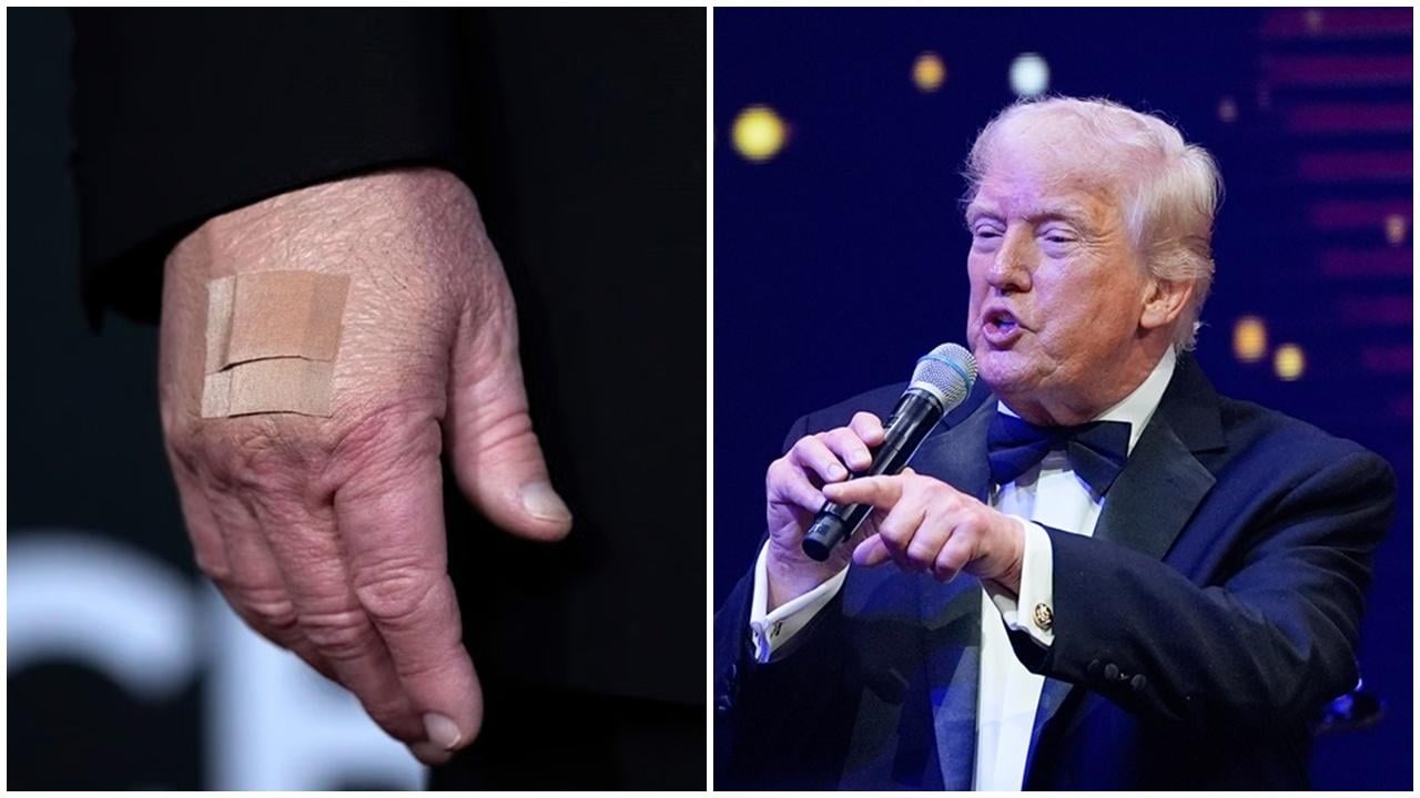 特朗普：手瘀由服用阿士匹靈造成，後悔接受CT掃瞄令人質疑健康。(AP)