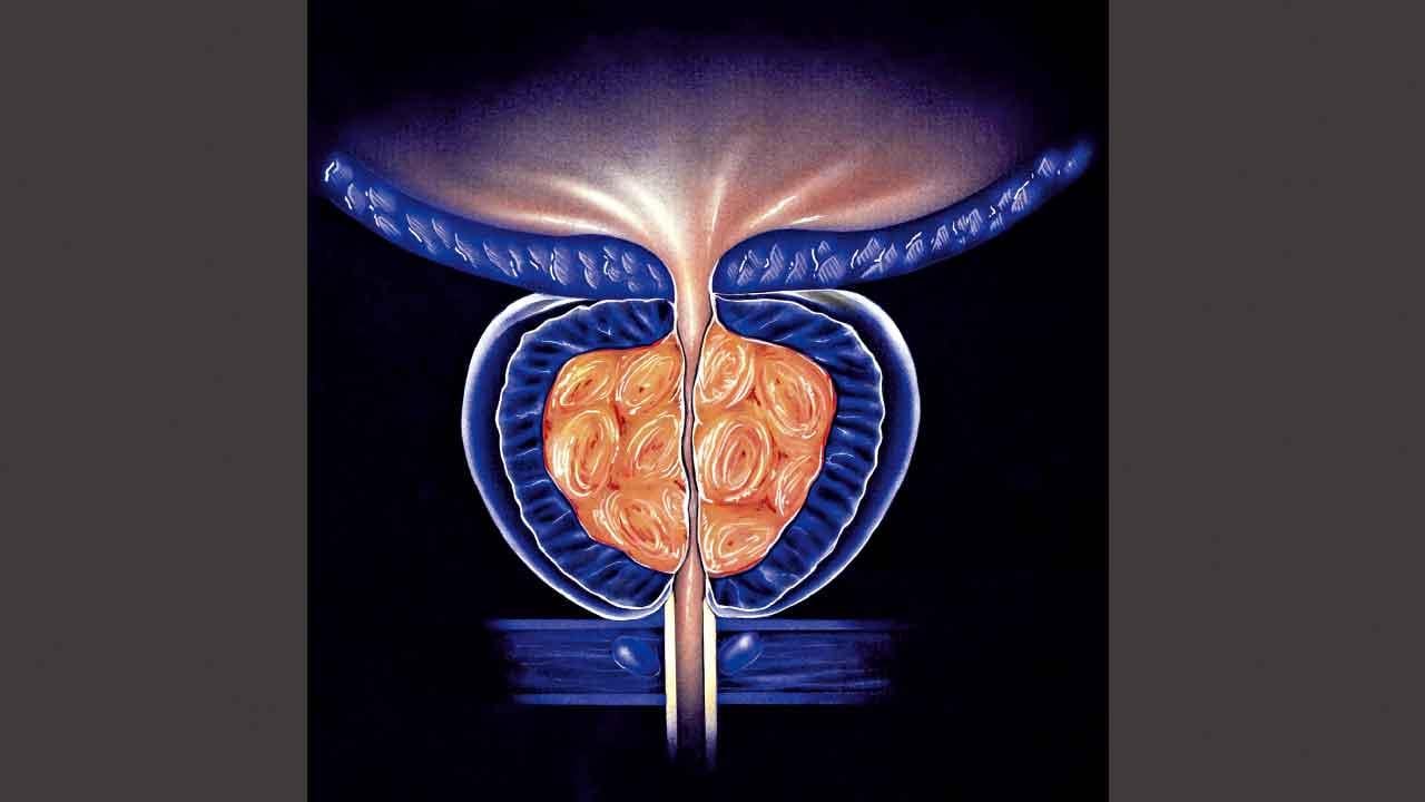 水蒸氣治前列腺肥大 保性功能