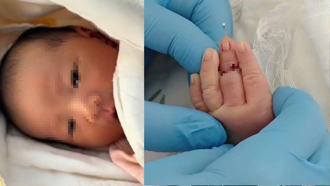 剪臍帶竟剪斷嬰兒手指 助產士解釋︰手亂動