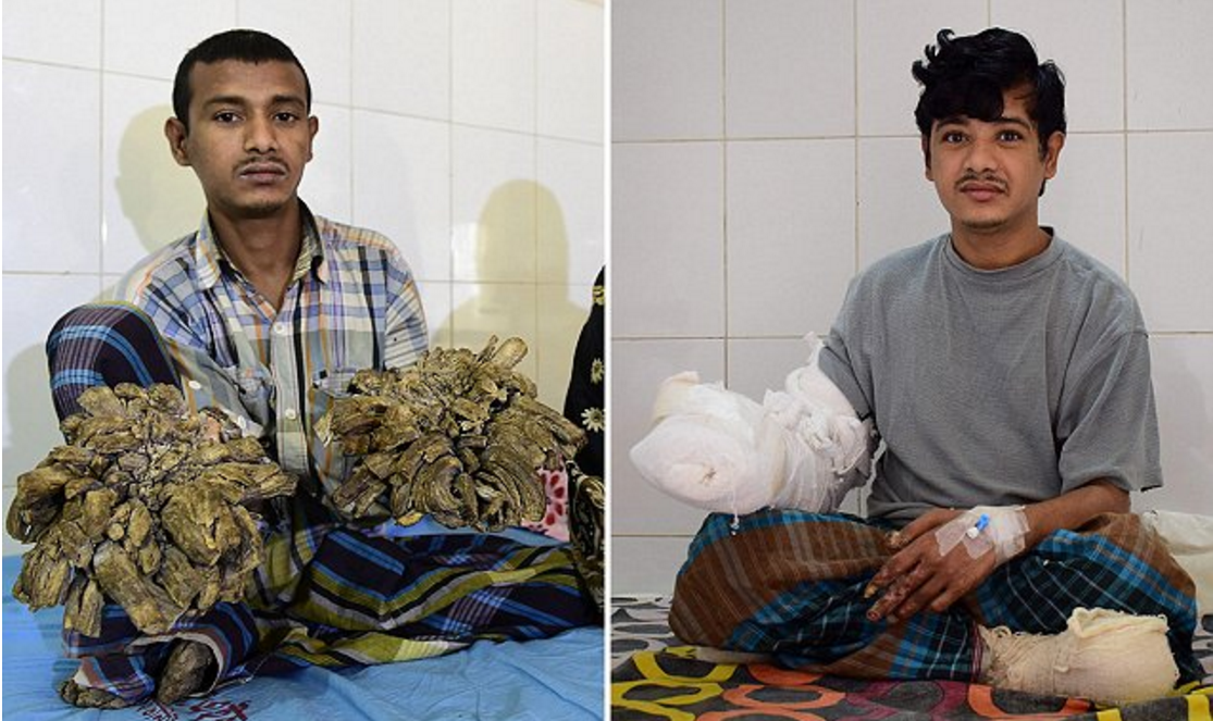 16次手術 治愈樹人症 