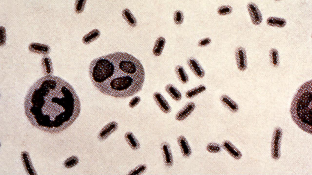 全美26種抗生素均無效 老婦遊印染超級惡菌亡