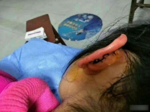 被老師扭裂耳仔 陝女童忍痛至放學