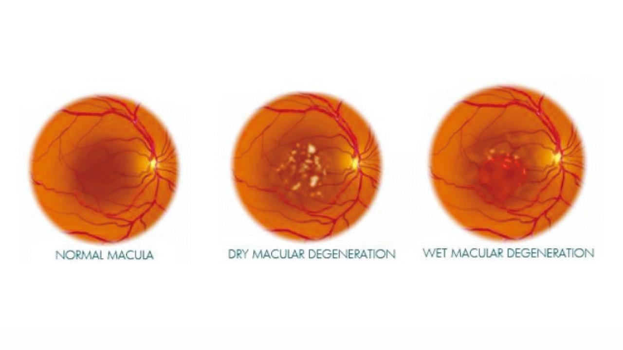 美診所幹細胞療法治黃斑病變  3老婦慘變盲