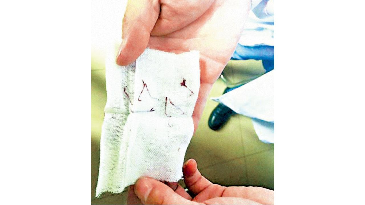 埋線隆鼻失敗 武漢女鼻頭生線剪不完