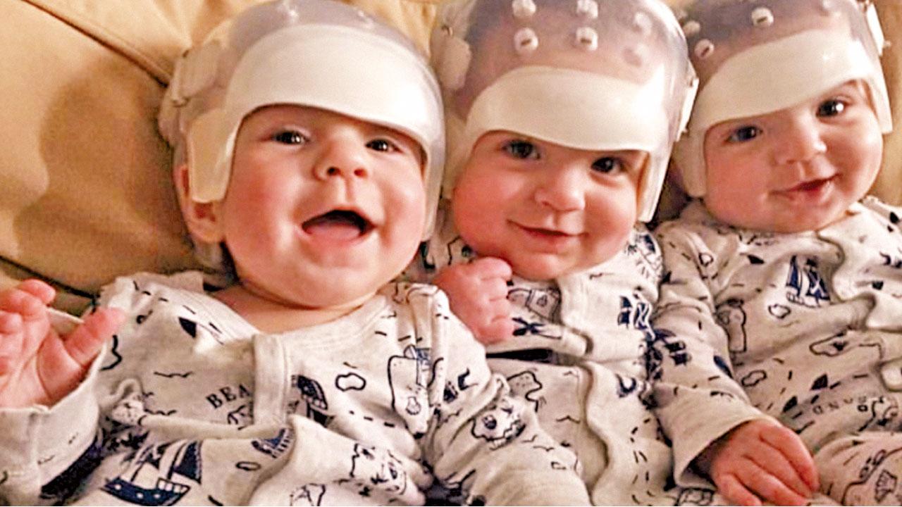 500萬億分之一機率 三胞胎腦囟過早生埋頭變形