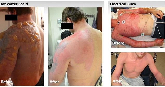 向燙傷噴幹細胞4天可換膚