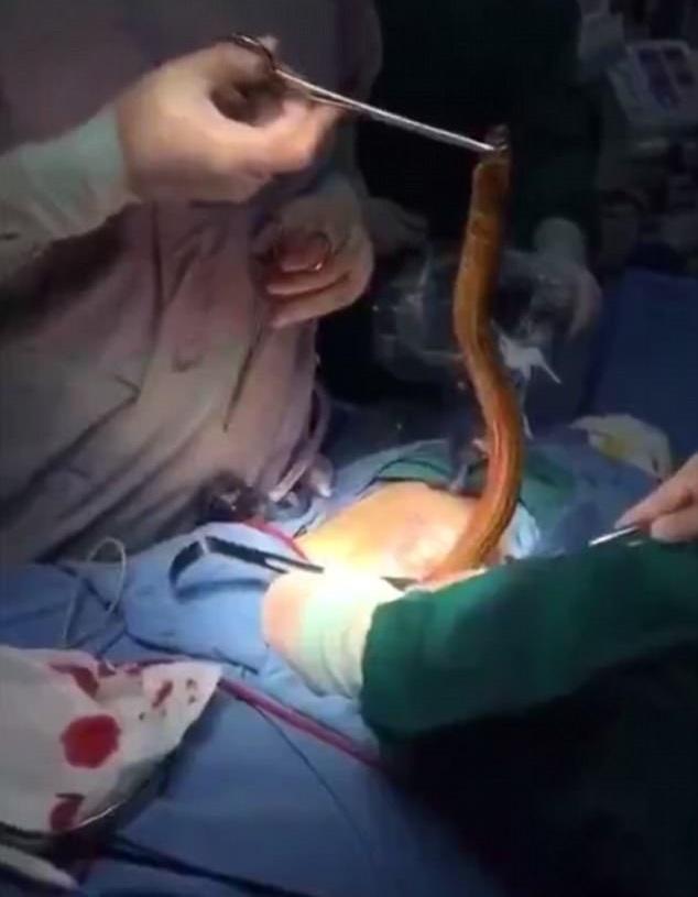 開刀鉗出巨鱔 腹中魚搞邊科