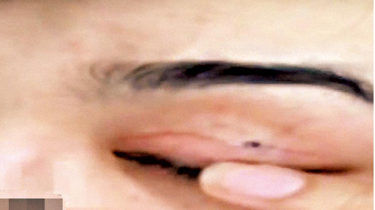 江蘇女割雙眼皮毀容 眼皮穿洞有淚水流出