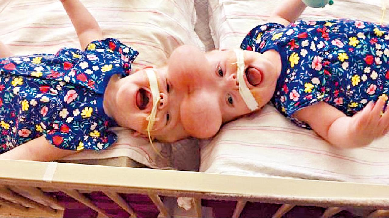 連頭B女成功分割 