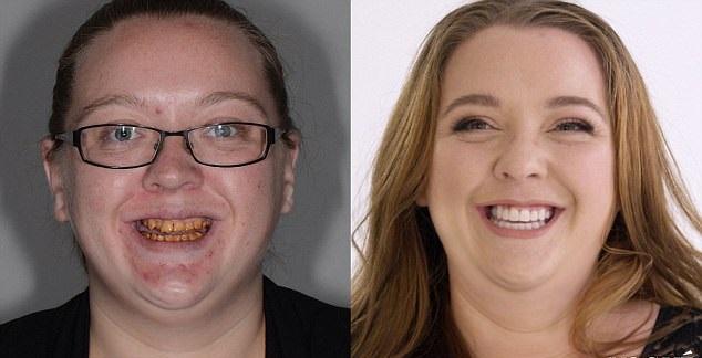 黃牙女獲贈45萬皓齒