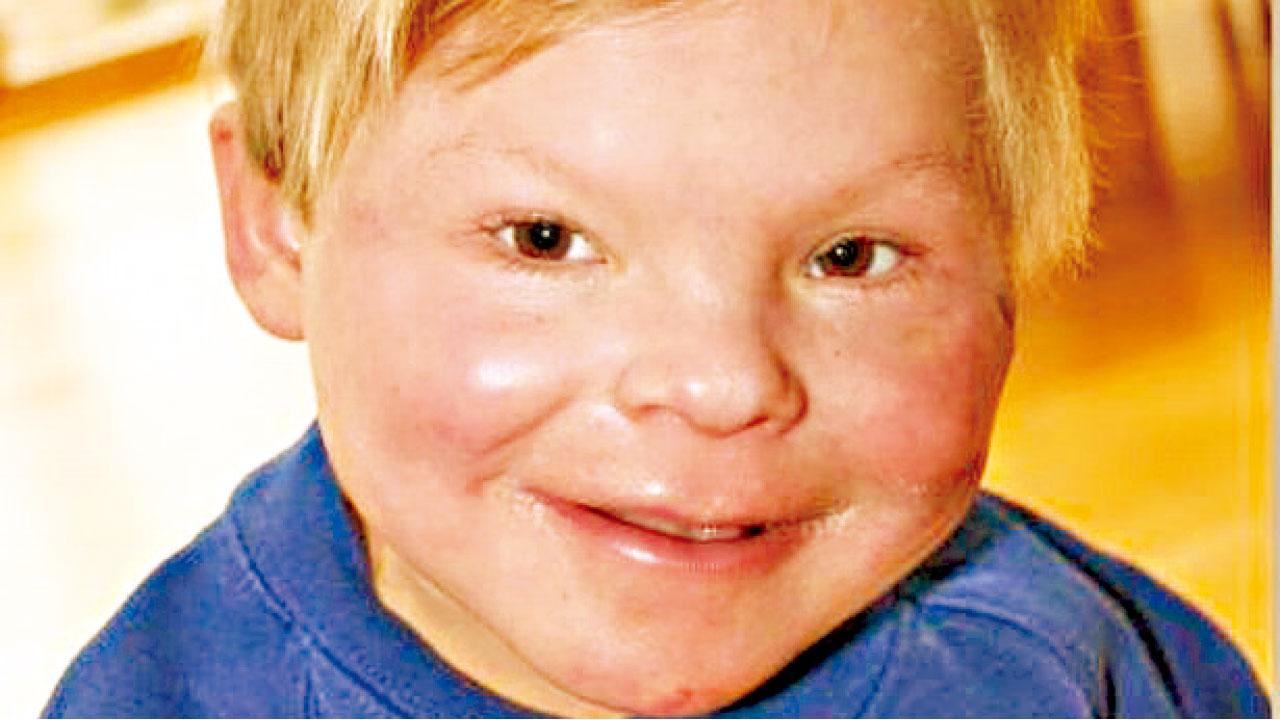 染色體異常所致  不老13歲少年像3歲童