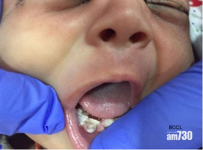 男嬰出生有7隻牙 需做手術拔除