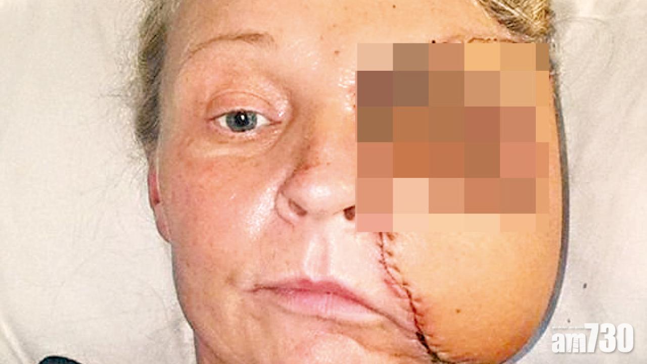 英婦小傷口染食肉菌  臉變「燶氣球」險死