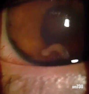 【有片恐怖慎入】少年眼球生蟲周圍捐