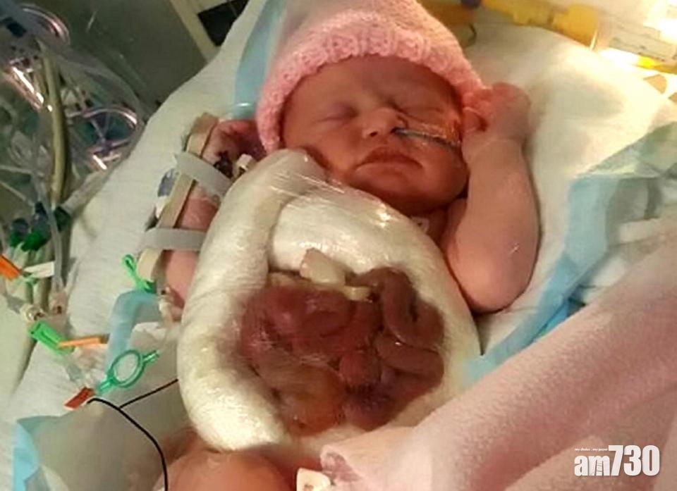 腸臟生於體外 女嬰靠保鮮紙保命