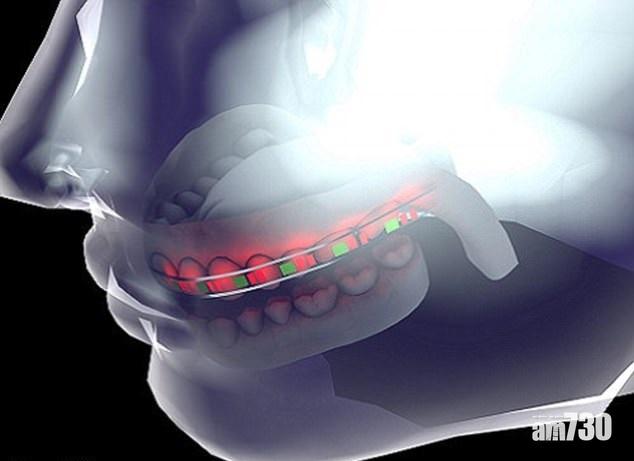 聰明牙箍靠照燈