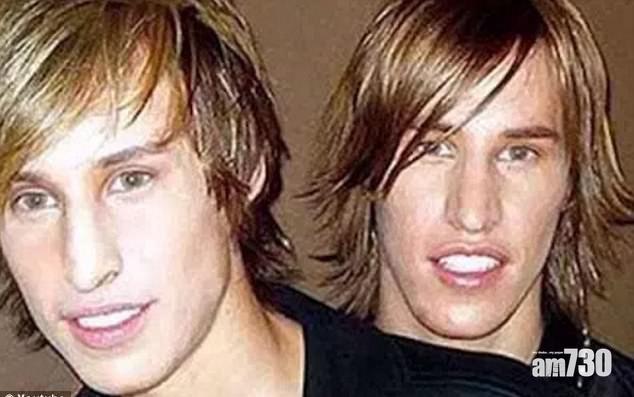 孖仔整容仿製畢佬