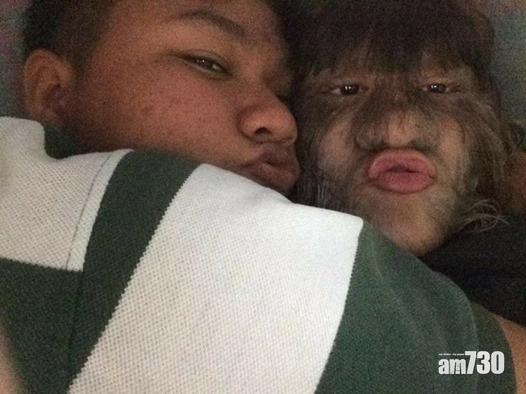 【祝你幸福】泰國「狼人少女」嫁人後剃面毛露真樣