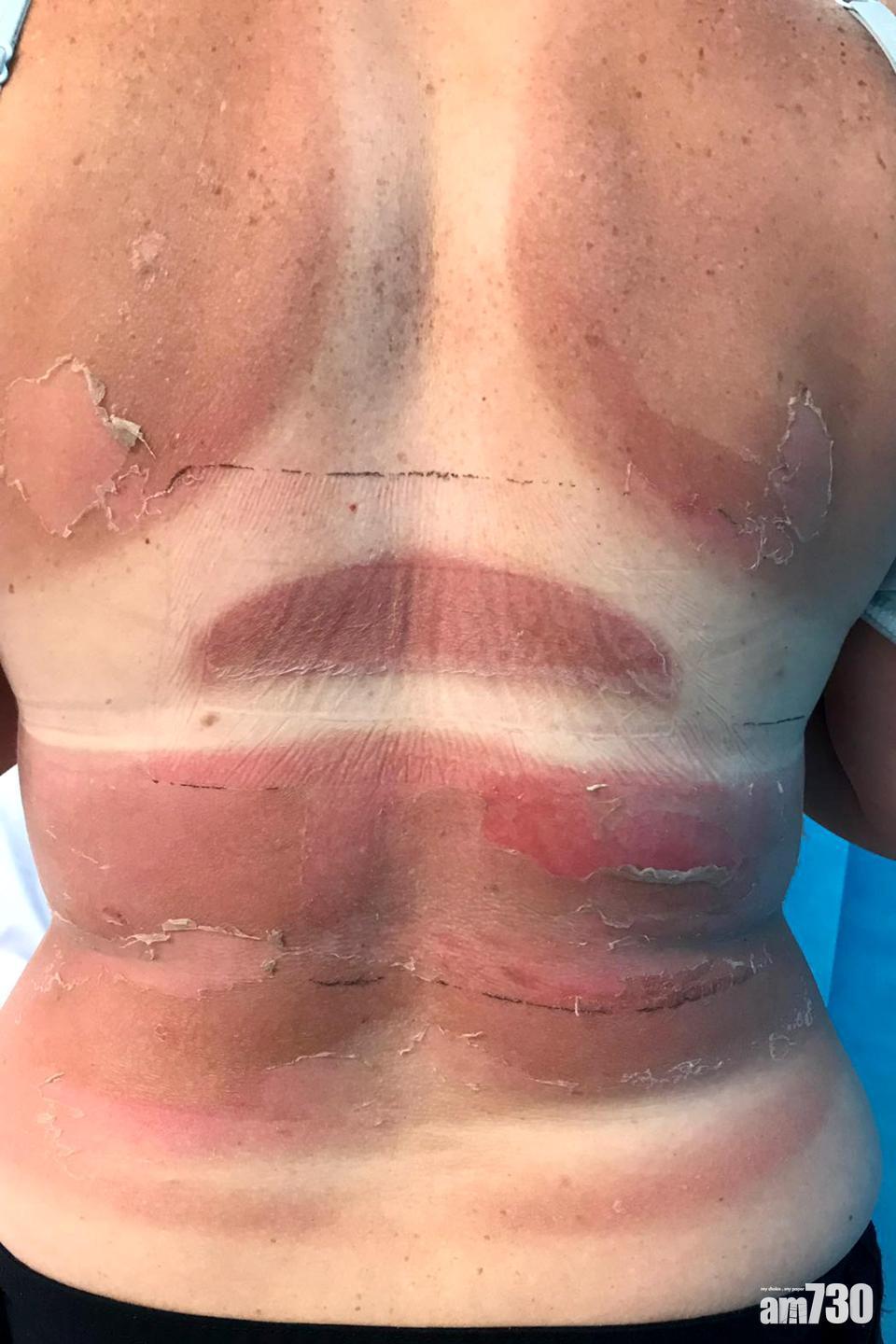 搽SPF50防曬仍曬傷 澳女慘變皮膚癌高危人士