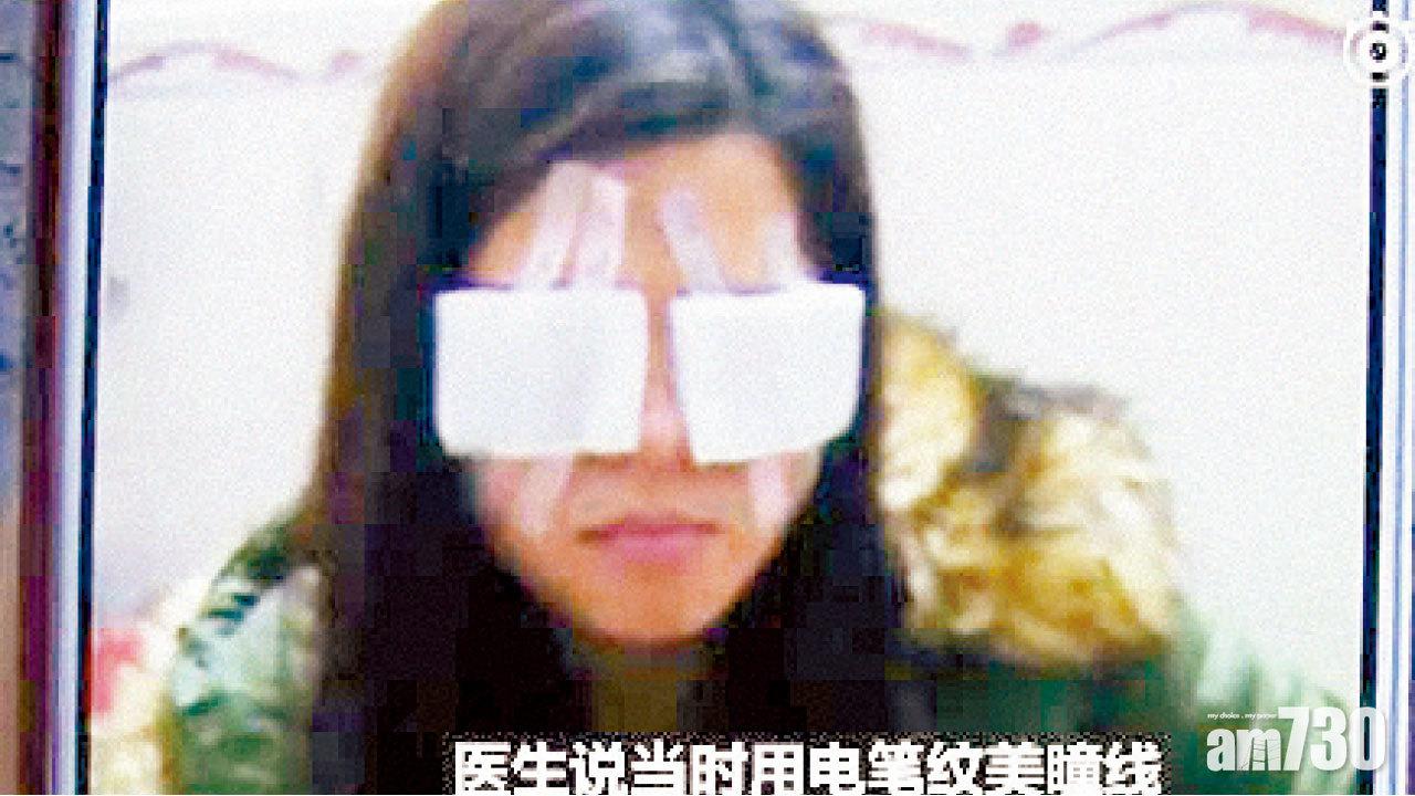 穗女紋眼線 遭電筆灼傷險盲