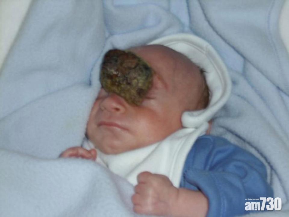 出生時腦生體外 10歲男孩奇蹟生存