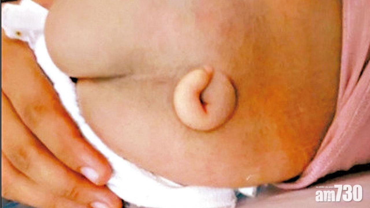 胚胎發育期缺葉酸 東莞嬰屁股長「尾巴」