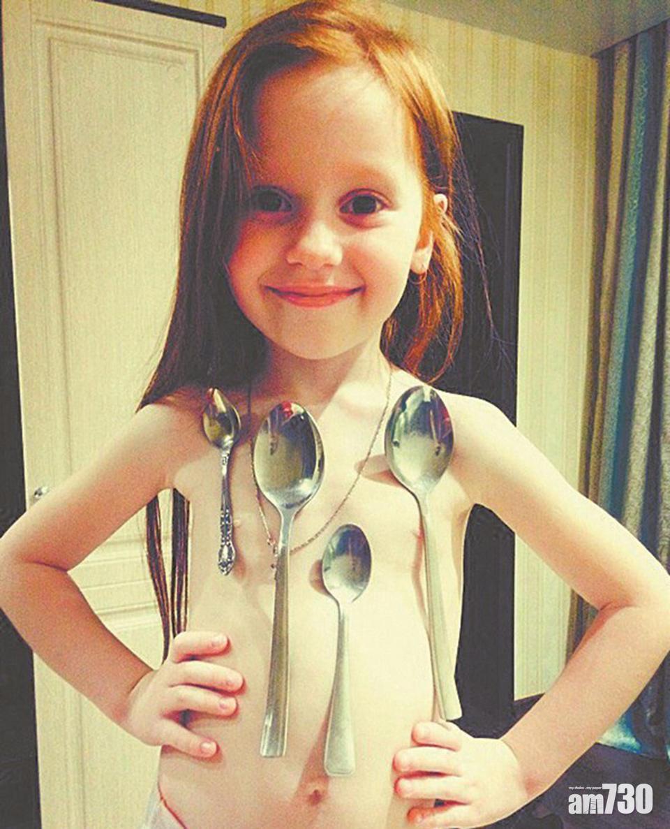 「萬磁王」女孩 10隻鐵匙羹黏上身