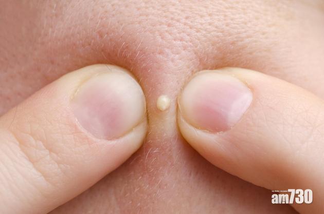 中意睇擠瘡片？內地心理學者：滿足心底本能