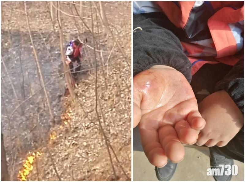 小學生自行滅山火燒傷手 父：值得表揚但不值提倡