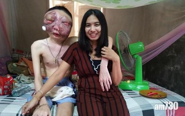 男友染眼疾毀容　泰女三年來不離不棄