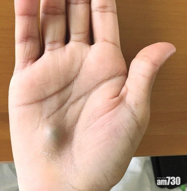 【健康警號】看牙醫後掌心出現腫塊 原來是……