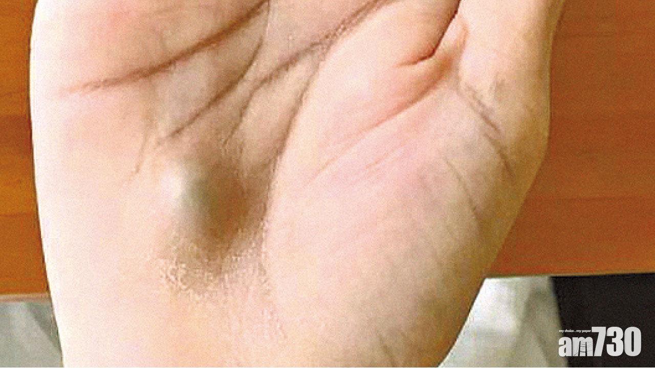看牙醫後掌心現腫塊 心臟受感染