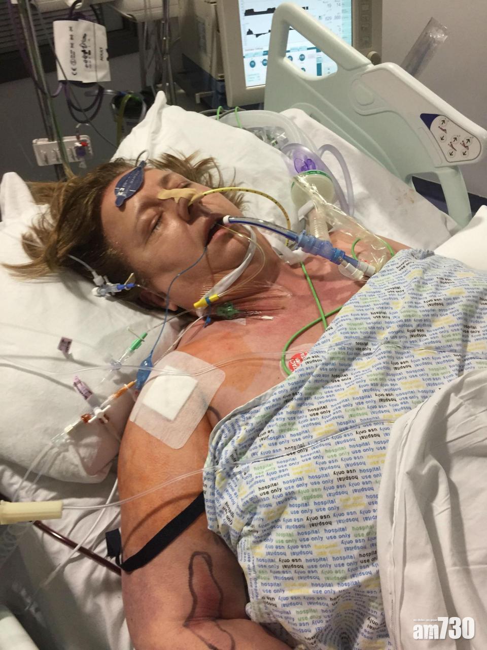 遭紙割傷感染 英婦需截4肢保命