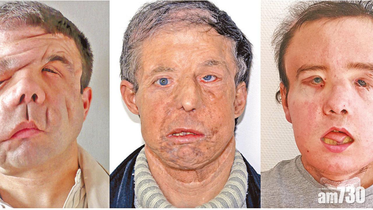 「像經歷核戰」 法男兩度換面