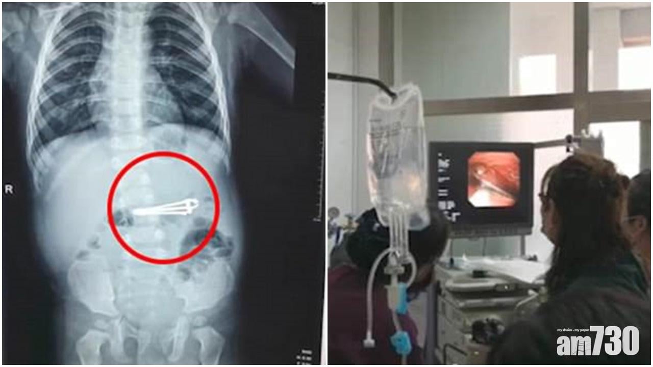 【好危險啊！】16個月大男嬰誤吞2.4吋長指甲鉗