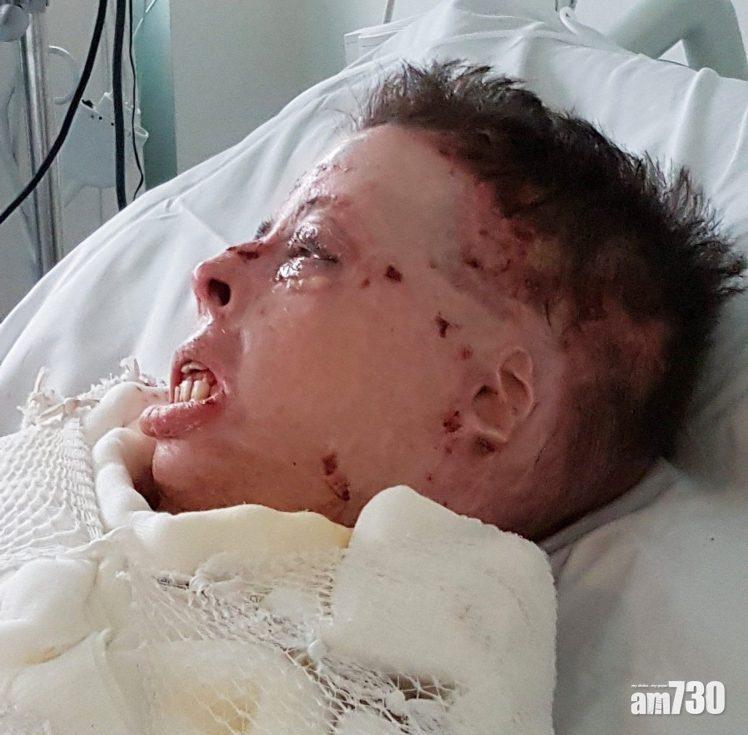 【好心無好報】鄰居情侶吵架當和事佬　英女遭潑電油燒身毀容