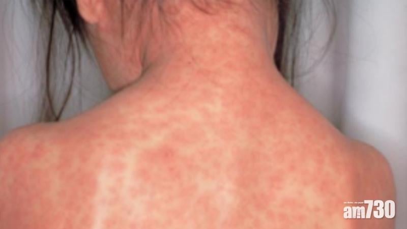 日本麻疹疫情擴散至東京大阪 確疹患者破百