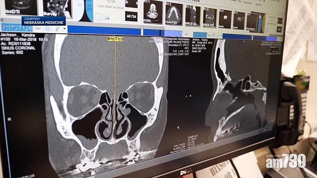 【恐怖醫學】中年婦5年持續流鼻水 原來是「腦水」