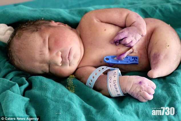 【罕見病症】婦誕「美人魚」寶寶 出生15分鐘夭折