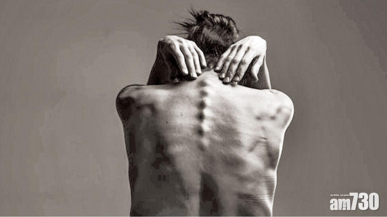 椎間盤突出壓神經 微創切除緩痛楚